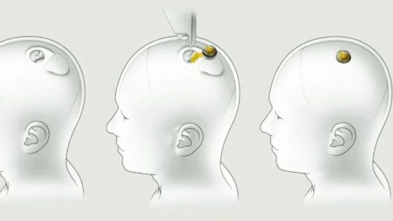 Neuralink Cihazında Karşılaşılan Sorunlar Var...