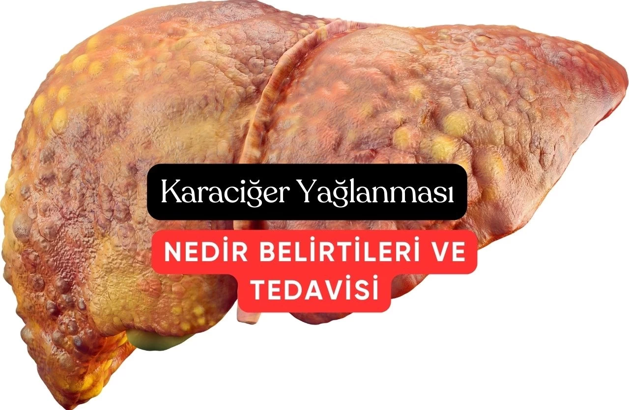 Karaciğer Yağlanması Çoğu İnsanda Sinsice İlerleyen Öldürücü Hastalık