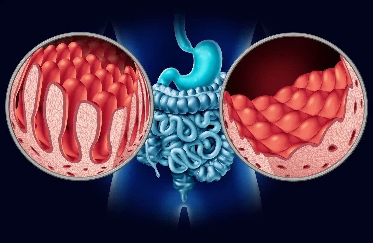 Çölyak Hastalığı (Dermatıtıs Herpetıformıs) Nedir?