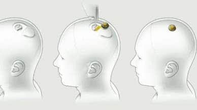 Neuralink Cihazında Karşılaşılan Sorunlar Var...