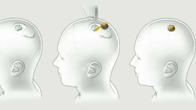 Neuralink Cihazında Karşılaşılan Sorunlar Var...