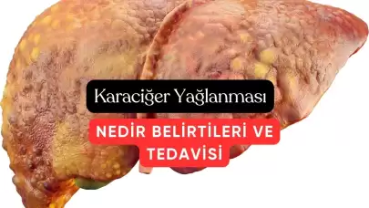 Karaciğer Yağlanması Çoğu İnsanda Sinsice İlerleyen Öldürücü Hastalık