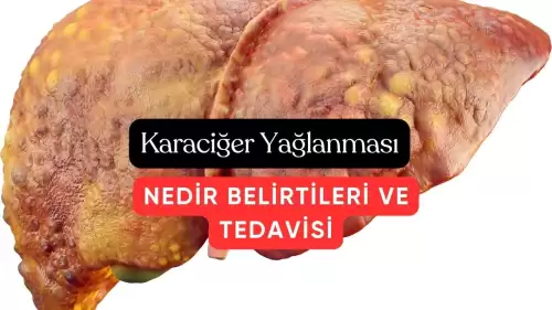 Karaciğer Yağlanması Çoğu İnsanda Sinsice İlerleyen Öldürücü Hastalık