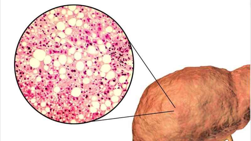 Karaciğer Yağlanması- Adım Adım Ölüme Götüren Hastalık
