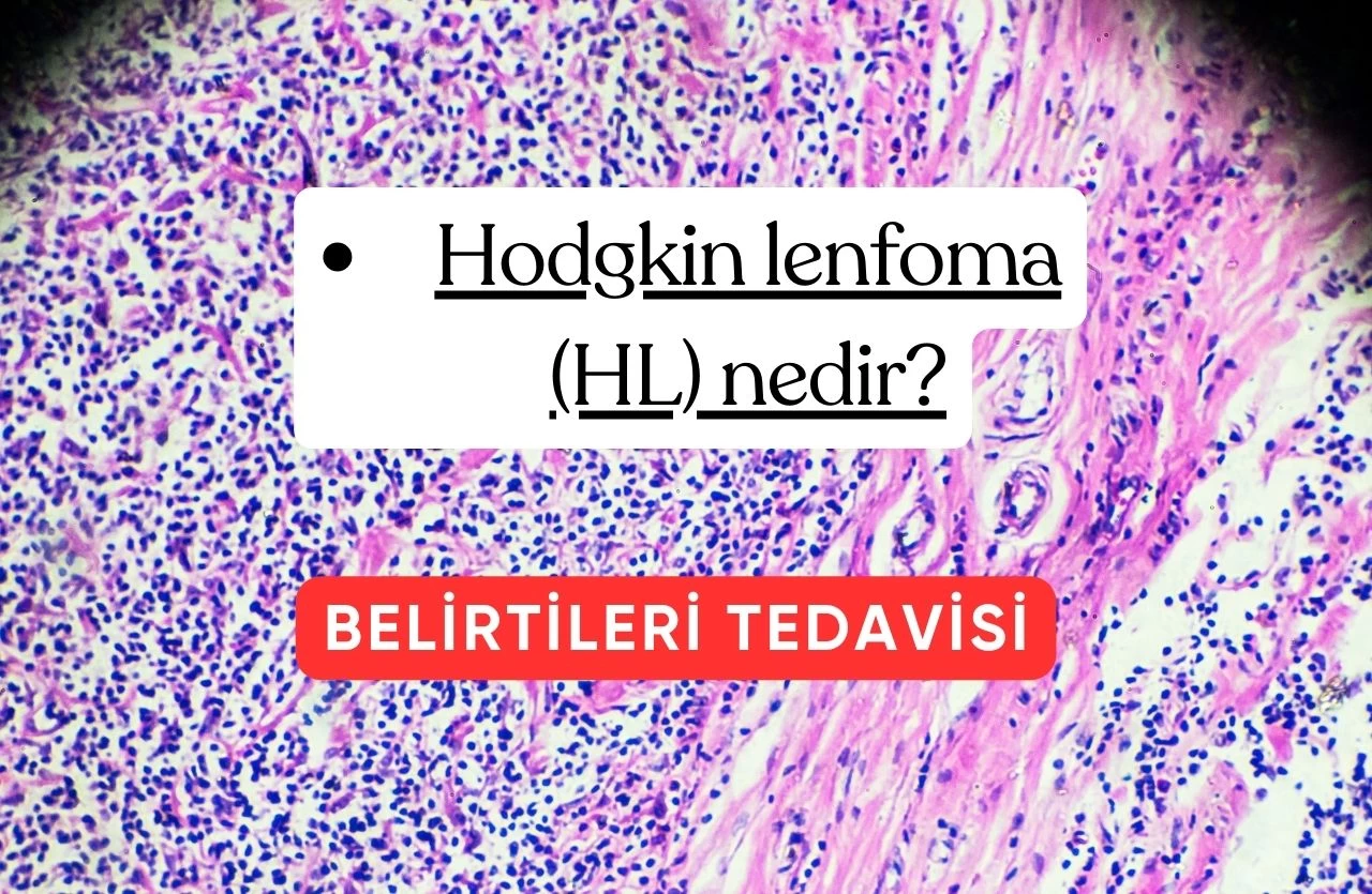 HODGKIN LENFOMA (HL) NEDİR?